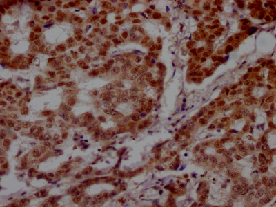 IHC image of CSB-RA160472A0HU diluted at 1:100 and staining in paraffin-embedded human breast cancer performed on a Leica BondTM system. After dewaxing and hydration, antigen retrieval was mediated by high pressure in a citrate buffer (pH 6.0). Section was blocked with 10% normal goat serum 30min at RT. Then primary antibody (1% BSA) was incubated at 4°C overnight. The primary is detected by a Goat anti-rabbit IgG polymer labeled by HRP and visualized using 0.05% DAB.