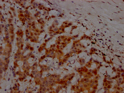 IHC image of CSB-RA166706A0HU diluted at 1:100 and staining in paraffin-embedded human breast cancer performed on a Leica BondTM system. After dewaxing and hydration, antigen retrieval was mediated by high pressure in a citrate buffer (pH 6.0). Section was blocked with 10% normal goat serum 30min at RT. Then primary antibody (1% BSA) was incubated at 4°C overnight. The primary is detected by a Goat anti-rabbit IgG polymer labeled by HRP and visualized using 0.05% DAB. IHC image of CSB-RA166706A0HU diluted at 1:100 and staining in paraffin-embedded human breast cancer performed on a Leica BondTM system. After dewaxing and hydration, antigen retrieval was mediated by high pressure in a citrate buffer (pH 6.0). Section was blocked with 10% normal goat serum 30min at RT. Then primary antibody (1% BSA) was incubated at 4°C overnight. The primary is detected by a Goat anti-rabbit IgG polymer labeled by HRP and visualized using 0.05% DAB.