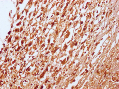 IHC image of CSB-RA227095A0HU diluted at 1:100 and staining in paraffin-embedded human melanoma cancer performed on a Leica BondTM system. After dewaxing and hydration, antigen retrieval was mediated by high pressure in a citrate buffer (pH 6.0). Section was blocked with 10% normal goat serum 30min at RT. Then primary antibody (1% BSA) was incubated at 4°C overnight. The primary is detected by a Goat anti-rabbit IgG polymer labeled by HRP and visualized using 0.05% DAB.