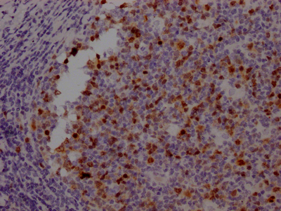 IHC image of CSB-RA230110A0HU diluted at 1:100 and staining in paraffin-embedded human tonsil tissue performed on a Leica BondTM system. After dewaxing and hydration, antigen retrieval was mediated by high pressure in a citrate buffer (pH 6.0). Section was blocked with 10% normal goat serum 30min at RT. Then primary antibody (1% BSA) was incubated at 4°C overnight. The primary is detected by a Goat anti-rabbit IgG polymer labeled by HRP and visualized using 0.05% DAB.