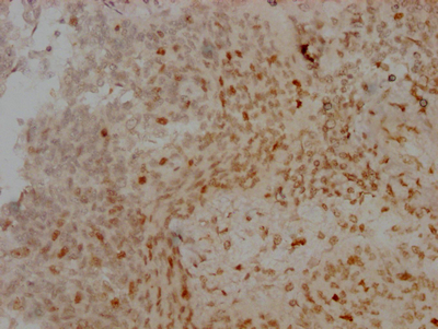 IHC image of CSB-RA230110A0HU diluted at 1:100 and staining in paraffin-embedded human cervical cancer performed on a Leica BondTM system. After dewaxing and hydration, antigen retrieval was mediated by high pressure in a citrate buffer (pH 6.0). Section was blocked with 10% normal goat serum 30min at RT. Then primary antibody (1% BSA) was incubated at 4°C overnight. The primary is detected by a Goat anti-rabbit IgG polymer labeled by HRP and visualized using 0.05% DAB.
