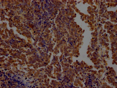 IHC image of CSB-RA232619A0HU diluted at 1:100 and staining in paraffin-embedded human lung cancer performed on a Leica BondTM system. After dewaxing and hydration, antigen retrieval was mediated by high pressure in a citrate buffer (pH 6.0). Section was blocked with 10% normal goat serum 30min at RT. Then primary antibody (1% BSA) was incubated at 4°C overnight. The primary is detected by a Goat anti-rabbit IgG polymer labeled by HRP and visualized using 0.05% DAB.