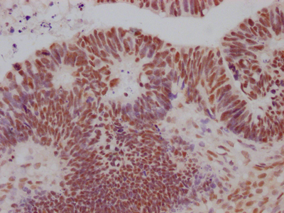 IHC image of CSB-RA242724A0HU diluted at 1:100 and staining in paraffin-embedded human ovarian cancer performed on a Leica BondTM system. After dewaxing and hydration, antigen retrieval was mediated by high pressure in a citrate buffer (pH 6.0). Section was blocked with 10% normal goat serum 30min at RT. Then primary antibody (1% BSA) was incubated at 4°C overnight. The primary is detected by a Goat anti-rabbit IgG polymer labeled by HRP and visualized using 0.05% DAB.