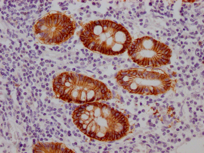 IHC image of CSB-RA245537A0HU diluted at 1:100 and staining in paraffin-embedded human colon cancer performed on a Leica BondTM system. After dewaxing and hydration, antigen retrieval was mediated by high pressure in a citrate buffer (pH 6.0). Section was blocked with 10% normal goat serum 30min at RT. Then primary antibody (1% BSA) was incubated at 4°C overnight. The primary is detected by a Goat anti-rabbit IgG polymer labeled by HRP and visualized using 0.05% DAB.