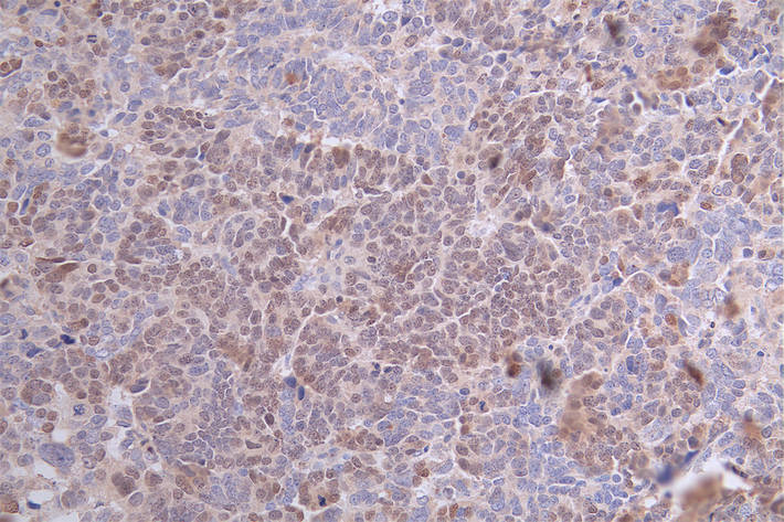 IHC image of CSB-RA24801:50A0HU diluted at 1:100 and staining in paraffin-embedded human ovarian cancer performed on a Leica BondTM system. After dewaxing and hydration, antigen retrieval was mediated by high pressure in a citrate buffer (pH 6.0). Section was blocked with 10% normal goat serum 30min at RT. Then primary antibody (1% BSA) was incubated at 4°C overnight. The primary is detected by a Goat anti-rabbit polymer IgG labeled by HRP and visualized using 0.59% DAB. IHC image of CSB-RA24801:50A0HU diluted at 1:100 and staining in paraffin-embedded human ovarian cancer performed on a Leica BondTM system. After dewaxing and hydration, antigen retrieval was mediated by high pressure in a citrate buffer (pH 6.0). Section was blocked with 10% normal goat serum 30min at RT. Then primary antibody (1% BSA) was incubated at 4°C overnight. The primary is detected by a Goat anti-rabbit polymer IgG labeled by HRP and visualized using 0.59% DAB.