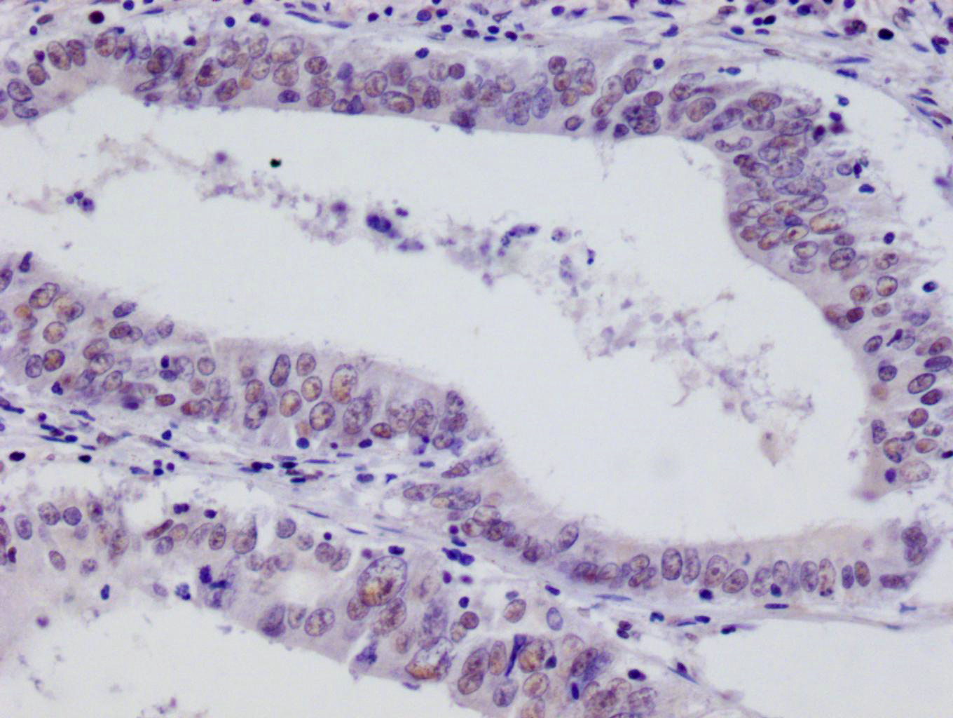 IHC image of CSB-RA256295A0HU diluted at 1:100 and staining in paraffin-embedded human colon cancer performed on a Leica BondTM system. After dewaxing and hydration, antigen retrieval was mediated by high pressure in a citrate buffer (pH 6.0). Section was blocked with 10% normal goat serum 30min at RT. Then primary antibody (1% BSA) was incubated at 4°C overnight. The primary is detected by a Goat anti-rabbit polymer IgG labeled by HRP and visualized using 0.05% DAB.