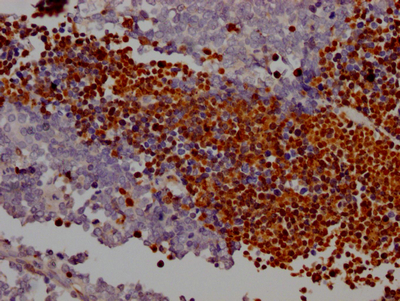 IHC image of CSB-RA258431A0HU diluted at 1:100 and staining in paraffin-embedded human lung cancer performed on a Leica BondTM system. After dewaxing and hydration, antigen retrieval was mediated by high pressure in a citrate buffer (pH 6.0). Section was blocked with 10% normal goat serum 30min at RT. Then primary antibody (1% BSA) was incubated at 4°C overnight. The primary is detected by a Goat anti-rabbit IgG polymer labeled by HRP and visualized using 0.05% DAB. IHC image of CSB-RA258431A0HU diluted at 1:100 and staining in paraffin-embedded human lung cancer performed on a Leica BondTM system. After dewaxing and hydration, antigen retrieval was mediated by high pressure in a citrate buffer (pH 6.0). Section was blocked with 10% normal goat serum 30min at RT. Then primary antibody (1% BSA) was incubated at 4°C overnight. The primary is detected by a Goat anti-rabbit IgG polymer labeled by HRP and visualized using 0.05% DAB.