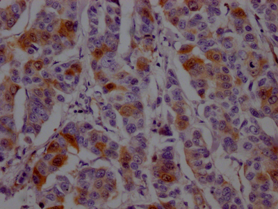 IHC image of CSB-RA264582A0HU diluted at 1:100 and staining in paraffin-embedded human breast cancer performed on a Leica BondTM system. After dewaxing and hydration, antigen retrieval was mediated by high pressure in a citrate buffer (pH 6.0). Section was blocked with 10% normal goat serum 30min at RT. Then primary antibody (1% BSA) was incubated at 4°C overnight. The primary is detected by a Goat anti-rabbit IgG polymer labeled by HRP and visualized using 0.05% DAB.