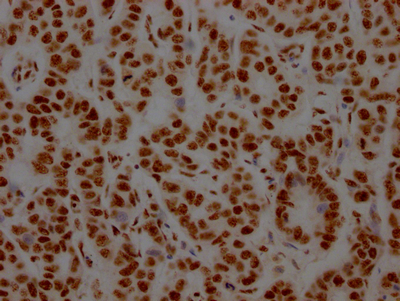 IHC image of CSB-RA273277A0HU diluted at 1:100 and staining in paraffin-embedded human breast cancer performed on a Leica BondTM system. After dewaxing and hydration, antigen retrieval was mediated by high pressure in a citrate buffer (pH 6.0). Section was blocked with 10% normal goat serum 30min at RT. Then primary antibody (1% BSA) was incubated at 4°C overnight. The primary is detected by a Goat anti-rabbit IgG polymer labeled by HRP and visualized using 0.05% DAB.