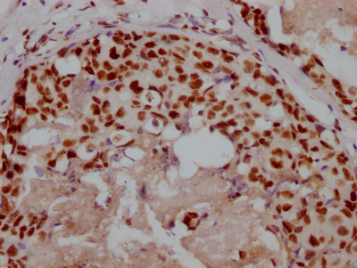 IHC image of CSB-RA276627A0HU diluted at 1:100 and staining in paraffin-embedded human breast cancer performed on a Leica BondTM system. After dewaxing and hydration, antigen retrieval was mediated by high pressure in a citrate buffer (pH 6.0). Section was blocked with 10% normal goat serum 30min at RT. Then primary antibody (1% BSA) was incubated at 4°C overnight. The primary is detected by a Goat anti-rabbit IgG polymer labeled by HRP and visualized using 0.05% DAB.