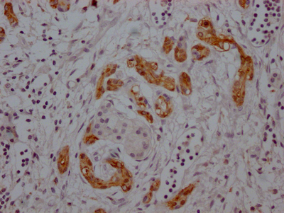 IHC image of CSB-RA276759A0HU diluted at 1:100 and staining in paraffin-embedded human pancreatic cancer performed on a Leica BondTM system. After dewaxing and hydration, antigen retrieval was mediated by high pressure in a citrate buffer (pH 6.0). Section was blocked with 10% normal goat serum 30min at RT. Then primary antibody (1% BSA) was incubated at 4°C overnight. The primary is detected by a Goat anti-rabbit IgG polymer labeled by HRP and visualized using 0.05% DAB. IHC image of CSB-RA276759A0HU diluted at 1:100 and staining in paraffin-embedded human pancreatic cancer performed on a Leica BondTM system. After dewaxing and hydration, antigen retrieval was mediated by high pressure in a citrate buffer (pH 6.0). Section was blocked with 10% normal goat serum 30min at RT. Then primary antibody (1% BSA) was incubated at 4°C overnight. The primary is detected by a Goat anti-rabbit IgG polymer labeled by HRP and visualized using 0.05% DAB.