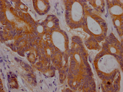 IHC image of CSB-RA280380A0HU diluted at 1:100 and staining in paraffin-embedded human colon cancer performed on a Leica BondTM system. After dewaxing and hydration, antigen retrieval was mediated by high pressure in a citrate buffer (pH 6.0). Section was blocked with 10% normal goat serum 30min at RT. Then primary antibody (1% BSA) was incubated at 4°C overnight. The primary is detected by a Goat anti-rabbit IgG polymer labeled by HRP and visualized using 0.05% DAB. IHC image of CSB-RA280380A0HU diluted at 1:100 and staining in paraffin-embedded human colon cancer performed on a Leica BondTM system. After dewaxing and hydration, antigen retrieval was mediated by high pressure in a citrate buffer (pH 6.0). Section was blocked with 10% normal goat serum 30min at RT. Then primary antibody (1% BSA) was incubated at 4°C overnight. The primary is detected by a Goat anti-rabbit IgG polymer labeled by HRP and visualized using 0.05% DAB.