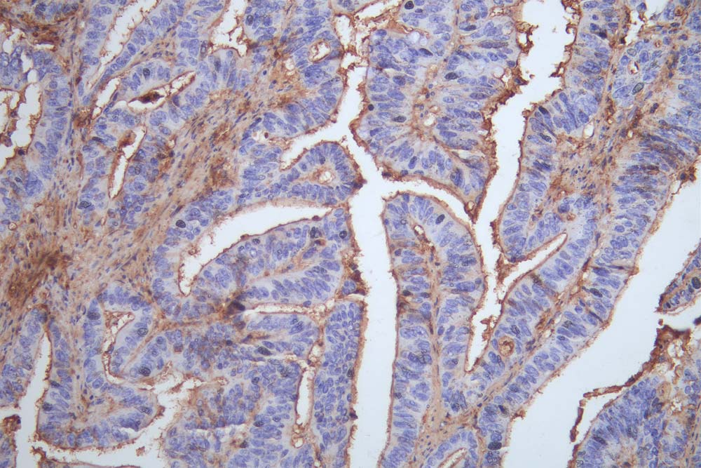 IHC image of CSB-RA293053A0HU diluted at 1:100 and staining in paraffin-embedded human colon cancer performed on a Leica BondTM system. After dewaxing and hydration, antigen retrieval was mediated by high pressure in a citrate buffer (pH 6.0). Section was blocked with 10% normal goat serum 30min at RT. Then primary antibody (1% BSA) was incubated at 4°C overnight. The primary is detected by a Goat anti-rabbit polymer IgG labeled by HRP and visualized using 0.05% DAB. IHC image of CSB-RA293053A0HU diluted at 1:100 and staining in paraffin-embedded human colon cancer performed on a Leica BondTM system. After dewaxing and hydration, antigen retrieval was mediated by high pressure in a citrate buffer (pH 6.0). Section was blocked with 10% normal goat serum 30min at RT. Then primary antibody (1% BSA) was incubated at 4°C overnight. The primary is detected by a Goat anti-rabbit polymer IgG labeled by HRP and visualized using 0.05% DAB.