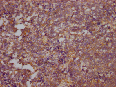 IHC image of CSB-RA546523A0HU diluted at 1:100 and staining in paraffin-embedded human lung cancer performed on a Leica BondTM system. After dewaxing and hydration, antigen retrieval was mediated by high pressure in a citrate buffer (pH 6.0). Section was blocked with 10% normal goat serum 30min at RT. Then primary antibody (1% BSA) was incubated at 4°C overnight. The primary is detected by a Goat anti-rabbit IgG polymer labeled by HRP and visualized using 0.05% DAB. IHC image of CSB-RA546523A0HU diluted at 1:100 and staining in paraffin-embedded human lung cancer performed on a Leica BondTM system. After dewaxing and hydration, antigen retrieval was mediated by high pressure in a citrate buffer (pH 6.0). Section was blocked with 10% normal goat serum 30min at RT. Then primary antibody (1% BSA) was incubated at 4°C overnight. The primary is detected by a Goat anti-rabbit IgG polymer labeled by HRP and visualized using 0.05% DAB.