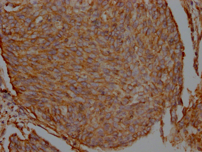 IHC image of CSB-RA548809A0HU diluted at 1:100 and staining in paraffin-embedded human cervical cancer performed on a Leica BondTM system. After dewaxing and hydration, antigen retrieval was mediated by high pressure in a citrate buffer (pH 6.0). Section was blocked with 10% normal goat serum 30min at RT. Then primary antibody (1% BSA) was incubated at 4°C overnight. The primary is detected by a Goat anti-rabbit IgG polymer labeled by HRP and visualized using 0.05% DAB. IHC image of CSB-RA548809A0HU diluted at 1:100 and staining in paraffin-embedded human cervical cancer performed on a Leica BondTM system. After dewaxing and hydration, antigen retrieval was mediated by high pressure in a citrate buffer (pH 6.0). Section was blocked with 10% normal goat serum 30min at RT. Then primary antibody (1% BSA) was incubated at 4°C overnight. The primary is detected by a Goat anti-rabbit IgG polymer labeled by HRP and visualized using 0.05% DAB.