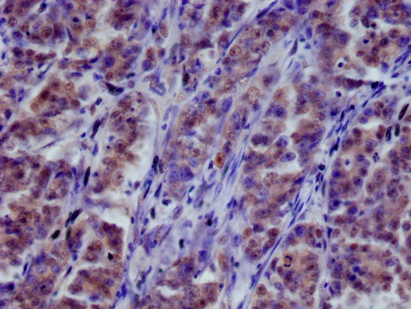 IHC image of CSB-RA556985A0HU diluted at 1:100 and staining in paraffin-embedded human colon cancer performed on a Leica BondTM system. After dewaxing and hydration, antigen retrieval was mediated by high pressure in a citrate buffer (pH 6.0). Section was blocked with 10% normal goat serum 30min at RT. Then primary antibody (1% BSA) was incubated at 4°C overnight. The primary is detected by a Goat anti-rabbit polymer IgG labeled by HRP and visualized using 0.05% DAB.