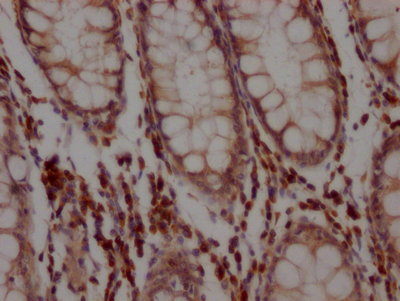 IHC image of CSB-RA564360A0HU diluted at 1:100 and staining in paraffin-embedded human colon cancer performed on a Leica BondTM system. After dewaxing and hydration, antigen retrieval was mediated by high pressure in a citrate buffer (pH 6.0). Section was blocked with 10% normal goat serum 30min at RT. Then primary antibody (1% BSA) was incubated at 4°C overnight. The primary is detected by a Goat anti-rabbit IgG polymer labeled by HRP and visualized using 0.05% DAB.