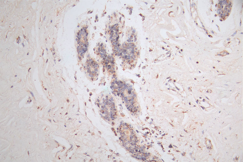 IHC image of CSB-RA566370A0HU diluted at 1:50 and staining in paraffin-embedded human breast cancer performed on a Leica BondTM system. After dewaxing and hydration, antigen retrieval was mediated by high pressure in a citrate buffer (pH 6.0). Section was blocked with 10% normal goat serum 30min at RT. Then primary antibody (1% BSA) was incubated at 4°C overnight. The primary is detected by a Goat anti-rabbit polymer IgG labeled by HRP and visualized using 0.15% DAB.