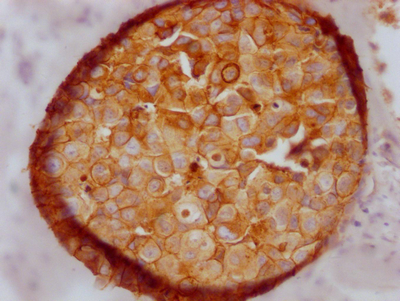 IHC image of CSB-RA576116A0HU diluted at 1:100 and staining in paraffin-embedded human breast cancer performed on a Leica BondTM system. After dewaxing and hydration, antigen retrieval was mediated by high pressure in a citrate buffer (pH 6.0). Section was blocked with 10% normal goat serum 30min at RT. Then primary antibody (1% BSA) was incubated at 4°C overnight. The primary is detected by a Goat anti-rabbit IgG polymer labeled by HRP and visualized using 0.05% DAB. IHC image of CSB-RA576116A0HU diluted at 1:100 and staining in paraffin-embedded human breast cancer performed on a Leica BondTM system. After dewaxing and hydration, antigen retrieval was mediated by high pressure in a citrate buffer (pH 6.0). Section was blocked with 10% normal goat serum 30min at RT. Then primary antibody (1% BSA) was incubated at 4°C overnight. The primary is detected by a Goat anti-rabbit IgG polymer labeled by HRP and visualized using 0.05% DAB.