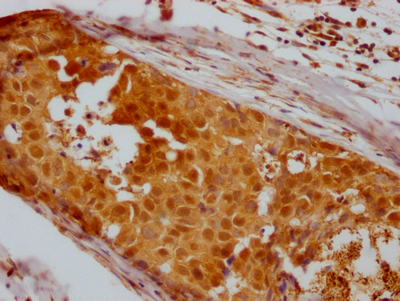 IHC image of CSB-RA593846A0HU diluted at 1:100 and staining in paraffin-embedded human breast cancer performed on a Leica BondTM system. After dewaxing and hydration, antigen retrieval was mediated by high pressure in a citrate buffer (pH 6.0). Section was blocked with 10% normal goat serum 30min at RT. Then primary antibody (1% BSA) was incubated at 4°C overnight. The primary is detected by a Goat anti-rabbit IgG polymer labeled by HRP and visualized using 0.05% DAB.