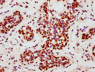 IHC image of CSB-RA008836A253phHU diluted at 1:100 and staining in paraffin-embedded human breast cancer performed on a Leica BondTM system. After dewaxing and hydration, antigen retrieval was mediated by high pressure in a citrate buffer (pH 6.0). Section was blocked with 10% normal goat serum 30min at RT. Then primary antibody (1% BSA) was incubated at 4°C overnight. The primary is detected by a biotinylated secondary antibody and visualized using an HRP conjugated SP system.