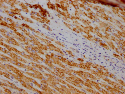IHC image of CSB-RA633872A0HU diluted at 1:100 and staining in paraffin-embedded human liver cancer performed on a Leica BondTM system. After dewaxing and hydration, antigen retrieval was mediated by high pressure in a citrate buffer (pH 6.0). Section was blocked with 10% normal goat serum 30min at RT. Then primary antibody (1% BSA) was incubated at 4°C overnight. The primary is detected by a Goat anti-rabbit IgG polymer labeled by HRP and visualized using 0.05% DAB.