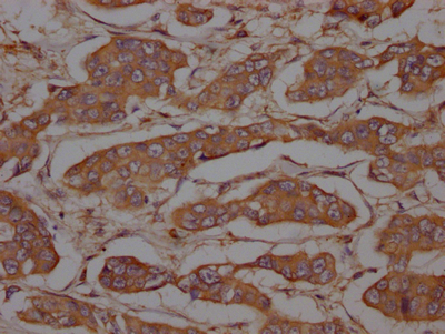 IHC image of CSB-RA634199A0HU diluted at 1:100 and staining in paraffin-embedded human breast cancer performed on a Leica BondTM system. After dewaxing and hydration, antigen retrieval was mediated by high pressure in a citrate buffer (pH 6.0). Section was blocked with 10% normal goat serum 30min at RT. Then primary antibody (1% BSA) was incubated at 4°C overnight. The primary is detected by a Goat anti-rabbit IgG polymer labeled by HRP and visualized using 0.05% DAB. IHC image of CSB-RA634199A0HU diluted at 1:100 and staining in paraffin-embedded human breast cancer performed on a Leica BondTM system. After dewaxing and hydration, antigen retrieval was mediated by high pressure in a citrate buffer (pH 6.0). Section was blocked with 10% normal goat serum 30min at RT. Then primary antibody (1% BSA) was incubated at 4°C overnight. The primary is detected by a Goat anti-rabbit IgG polymer labeled by HRP and visualized using 0.05% DAB.