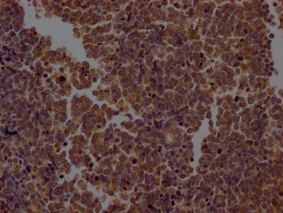 IHC image of CSB-RA782200A0HU diluted at 1:100 and staining in paraffin-embedded human lung cancer performed on a Leica BondTM system. After dewaxing and hydration, antigen retrieval was mediated by high pressure in a citrate buffer (pH 6.0). Section was blocked with 10% normal goat serum 30min at RT. Then primary antibody (1% BSA) was incubated at 4°C overnight. The primary is detected by a Goat anti-rabbit IgG polymer labeled by HRP and visualized using 0.05% DAB.