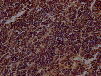 IHC image of CSB-RA798840A0HU diluted at 1:100 and staining in paraffin-embedded human lung cancer performed on a Leica BondTM system. After dewaxing and hydration, antigen retrieval was mediated by high pressure in a citrate buffer (pH 6.0). Section was blocked with 10% normal goat serum 30min at RT. Then primary antibody (1% BSA) was incubated at 4°C overnight. The primary is detected by a Goat anti-rabbit IgG polymer labeled by HRP and visualized using 0.05% DAB. IHC image of CSB-RA798840A0HU diluted at 1:100 and staining in paraffin-embedded human lung cancer performed on a Leica BondTM system. After dewaxing and hydration, antigen retrieval was mediated by high pressure in a citrate buffer (pH 6.0). Section was blocked with 10% normal goat serum 30min at RT. Then primary antibody (1% BSA) was incubated at 4°C overnight. The primary is detected by a Goat anti-rabbit IgG polymer labeled by HRP and visualized using 0.05% DAB.