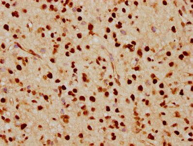 IHC image of CSB-RA880154A0HU diluted at 1:70 and staining in paraffin-embedded human glioma cancer performed on a Leica BondTM system. After dewaxing and hydration, antigen retrieval was mediated by high pressure in a citrate buffer (pH 6.0). Section was blocked with 10% normal goat serum 30min at RT. Then primary antibody (1% BSA) was incubated at 4°C overnight. The primary is detected by a biotinylated secondary antibody and visualized using an HRP conjugated SP system.