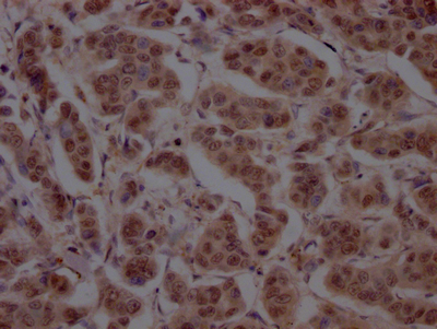 IHC image of CSB-RA898115A0HU diluted at 1:100 and staining in paraffin-embedded human breast cancer performed on a Leica BondTM system. After dewaxing and hydration, antigen retrieval was mediated by high pressure in a citrate buffer (pH 6.0). Section was blocked with 10% normal goat serum 30min at RT. Then primary antibody (1% BSA) was incubated at 4°C overnight. The primary is detected by a Goat anti-rabbit IgG polymer labeled by HRP and visualized using 0.05% DAB. IHC image of CSB-RA898115A0HU diluted at 1:100 and staining in paraffin-embedded human breast cancer performed on a Leica BondTM system. After dewaxing and hydration, antigen retrieval was mediated by high pressure in a citrate buffer (pH 6.0). Section was blocked with 10% normal goat serum 30min at RT. Then primary antibody (1% BSA) was incubated at 4°C overnight. The primary is detected by a Goat anti-rabbit IgG polymer labeled by HRP and visualized using 0.05% DAB.