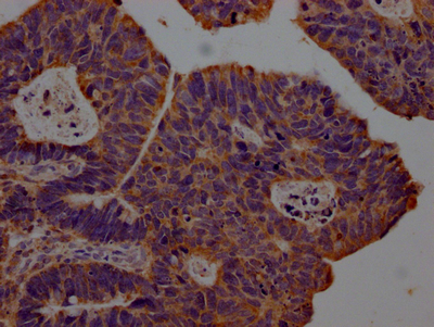 IHC image of CSB-RA903061A0HU diluted at 1:100 and staining in paraffin-embedded human ovarian cancer performed on a Leica BondTM system. After dewaxing and hydration, antigen retrieval was mediated by high pressure in a citrate buffer (pH 6.0). Section was blocked with 10% normal goat serum 30min at RT. Then primary antibody (1% BSA) was incubated at 4°C overnight. The primary is detected by a Goat anti-rabbit IgG polymer labeled by HRP and visualized using 0.05% DAB. IHC image of CSB-RA903061A0HU diluted at 1:100 and staining in paraffin-embedded human ovarian cancer performed on a Leica BondTM system. After dewaxing and hydration, antigen retrieval was mediated by high pressure in a citrate buffer (pH 6.0). Section was blocked with 10% normal goat serum 30min at RT. Then primary antibody (1% BSA) was incubated at 4°C overnight. The primary is detected by a Goat anti-rabbit IgG polymer labeled by HRP and visualized using 0.05% DAB.
