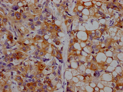 IHC image of CSB-RA925915A0HU diluted at 1:100 and staining in paraffin-embedded human liver cancer performed on a Leica BondTM system. After dewaxing and hydration, antigen retrieval was mediated by high pressure in a citrate buffer (pH 6.0). Section was blocked with 10% normal goat serum 30min at RT. Then primary antibody (1% BSA) was incubated at 4°C overnight. The primary is detected by a Goat anti-rabbit IgG polymer labeled by HRP and visualized using 0.05% DAB.