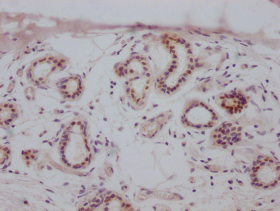 IHC image of CSB-RA942338A0HU diluted at 1:100 and staining in paraffin-embedded human breast cancer performed on a Leica BondTM system. After dewaxing and hydration, antigen retrieval was mediated by high pressure in a citrate buffer (pH 6.0). Section was blocked with 10% normal goat serum 30min at RT. Then primary antibody (1% BSA) was incubated at 4°C overnight. The primary is detected by a Goat anti-rabbit IgG polymer labeled by HRP and visualized using 0.05% DAB. IHC image of CSB-RA942338A0HU diluted at 1:100 and staining in paraffin-embedded human breast cancer performed on a Leica BondTM system. After dewaxing and hydration, antigen retrieval was mediated by high pressure in a citrate buffer (pH 6.0). Section was blocked with 10% normal goat serum 30min at RT. Then primary antibody (1% BSA) was incubated at 4°C overnight. The primary is detected by a Goat anti-rabbit IgG polymer labeled by HRP and visualized using 0.05% DAB.