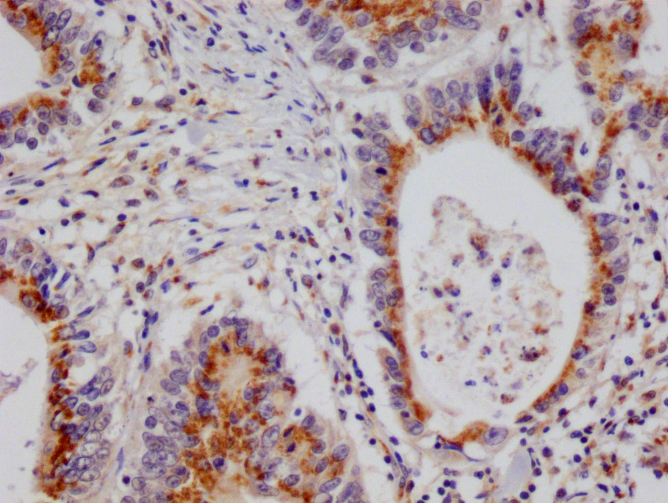 IHC image of CSB-RA943230A0HU diluted at 1:100 and staining in paraffin-embedded human colon cancer performed on a Leica BondTM system. After dewaxing and hydration, antigen retrieval was mediated by high pressure in a citrate buffer (pH 6.0). Section was blocked with 10% normal goat serum 30min at RT. Then primary antibody (1% BSA) was incubated at 4°C overnight. The primary is detected by a Goat anti-rabbit polymer IgG labeled by HRP and visualized using 0.05% DAB.