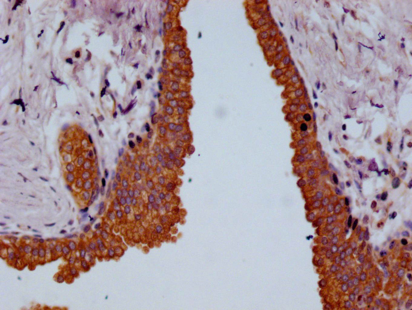 IHC image of CSB-RA959139A0HU diluted at 1:100 and staining in paraffin-embedded human prostate cancer performed on a Leica BondTM system. After dewaxing and hydration, antigen retrieval was mediated by high pressure in a citrate buffer (pH 6.0). Section was blocked with 10% normal goat serum 30min at RT. Then primary antibody (1% BSA) was incubated at 4°C overnight. The primary is detected by a Goat anti-rabbit polymer IgG labeled by HRP and visualized using 0.05% DAB.