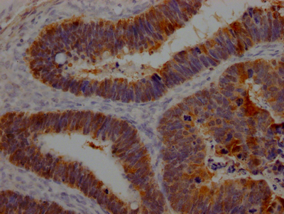 IHC image of CSB-RA970289A0HU diluted at 1:100 and staining in paraffin-embedded human ovarian cancer performed on a Leica BondTM system. After dewaxing and hydration, antigen retrieval was mediated by high pressure in a citrate buffer (pH 6.0). Section was blocked with 10% normal goat serum 30min at RT. Then primary antibody (1% BSA) was incubated at 4°C overnight. The primary is detected by a Goat anti-rabbit IgG polymer labeled by HRP and visualized using 0.05% DAB.