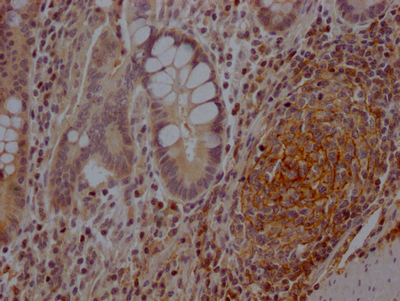 IHC image of CSB-RA978310A0HU diluted at 1:100 and staining in paraffin-embedded human colon cancer performed on a Leica BondTM system. After dewaxing and hydration, antigen retrieval was mediated by high pressure in a citrate buffer (pH 6.0). Section was blocked with 10% normal goat serum 30min at RT. Then primary antibody (1% BSA) was incubated at 4°C overnight. The primary is detected by a Goat anti-rabbit IgG polymer labeled by HRP and visualized using 0.05% DAB.