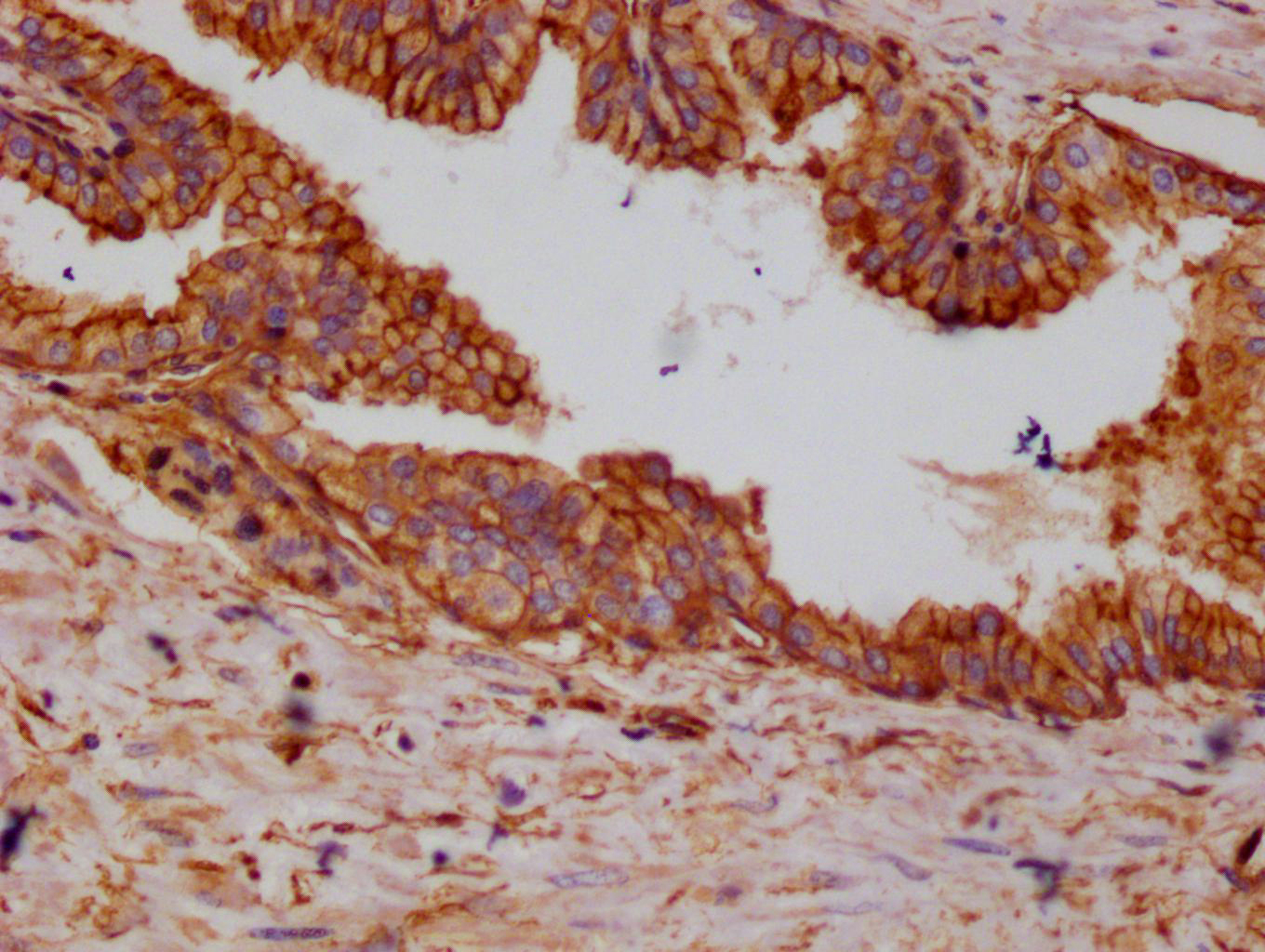 IHC image of CSB-RA987782A0HU diluted at 1:100 and staining in paraffin-embedded human prostate cancer performed on a Leica BondTM system. After dewaxing and hydration, antigen retrieval was mediated by high pressure in a citrate buffer (pH 6.0). Section was blocked with 10% normal goat serum 30min at RT. Then primary antibody (1% BSA) was incubated at 4°C overnight. The primary is detected by a Goat anti-rabbit polymer IgG labeled by HRP and visualized using 0.05% DAB.