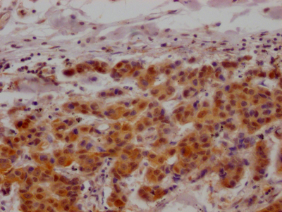 IHC image of CSB-RA990134A0HU diluted at 1:100 and staining in paraffin-embedded human breast cancer performed on a Leica BondTM system. After dewaxing and hydration, antigen retrieval was mediated by high pressure in a citrate buffer (pH 6.0). Section was blocked with 10% normal goat serum 30min at RT. Then primary antibody (1% BSA) was incubated at 4°C overnight. The primary is detected by a Goat anti-rabbit IgG polymer labeled by HRP and visualized using 0.05% DAB.