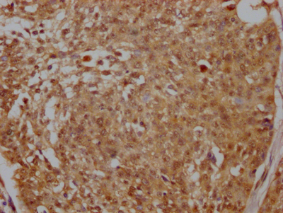 IHC image of CSB-RA999292A0HU diluted at 1:100 and staining in paraffin-embedded human cervical cancer performed on a Leica BondTM system. After dewaxing and hydration, antigen retrieval was mediated by high pressure in a citrate buffer (pH 6.0). Section was blocked with 10% normal goat serum 30min at RT. Then primary antibody (1% BSA) was incubated at 4°C overnight. The primary is detected by a Goat anti-rabbit IgG polymer labeled by HRP and visualized using 0.05% DAB.