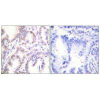 Immunohistochemistry analysis of paraffin-embedded human lung carcinoma tissue using CDK7 antibody. Immunohistochemistry analysis of paraffin-embedded human lung carcinoma tissue using CDK7 antibody.