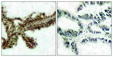 Immunohistochemical analysis of paraffin-embedded human lung carcinoma tissue, using Akt (Phospho-Thr308) Antibody (left) or the same antibody preincubated with blocking peptide (right).