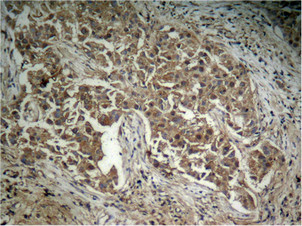 Immunohistochemical analysis of paraffin-embedded human lung carcinoma tissue, using Akt (Phospho-Thr308) Antibody.
