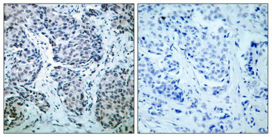 Immunohistochemical analysis of paraffin-embedded human breast carcinoma tissue using SEK1/MKK4(Phospho-Thr261) Antibody(left) or the same antibody preincubated with blocking peptide(right).