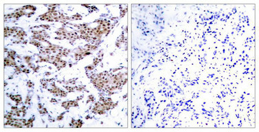 Immunohistochemical analysis of paraffin-embedded human breast carcinoma tissue using MEF2A(Phospho-Thr312) Antibody(left) or the same antibody preincubated with blocking peptide(right). Immunohistochemical analysis of paraffin-embedded human breast carcinoma tissue using MEF2A(Phospho-Thr312) Antibody(left) or the same antibody preincubated with blocking peptide(right).