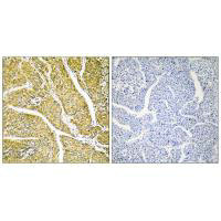 Immunohistochemistry analysis of paraffin-embedded human liver carcinoma tissue, using Cytochrome P450 2D6 antibody.