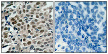 Immunohistochemical analysis of paraffin-embedded human breast carcinoma tissue using FKHRL1 (phospho-Ser253) antibody.