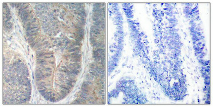 Immunohistochemical analysis of paraffin-embedded human colon carcinoma tissue using PKR(Phospho-Thr451) Antibody(left) or the same antibody preincubated with blocking peptide(right). Immunohistochemical analysis of paraffin-embedded human colon carcinoma tissue using PKR(Phospho-Thr451) Antibody(left) or the same antibody preincubated with blocking peptide(right).