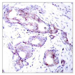 Immunohistochemical analysis of paraffin-embedded human breast carcinoma tissue using Myc(Phospho-Ser373) Antibody.